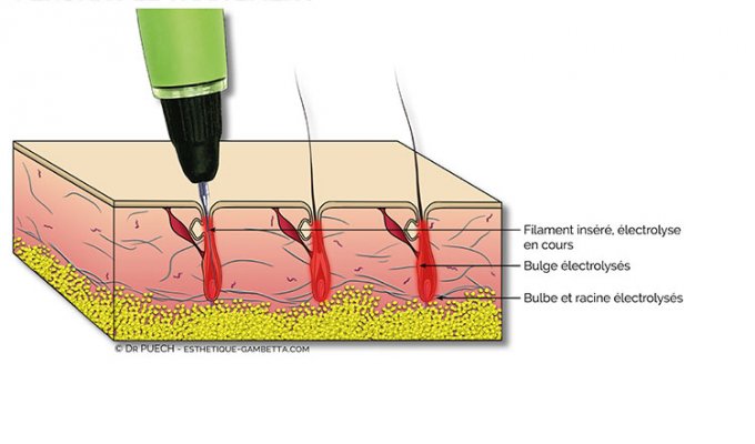 epilation définitive à l'électrolyse