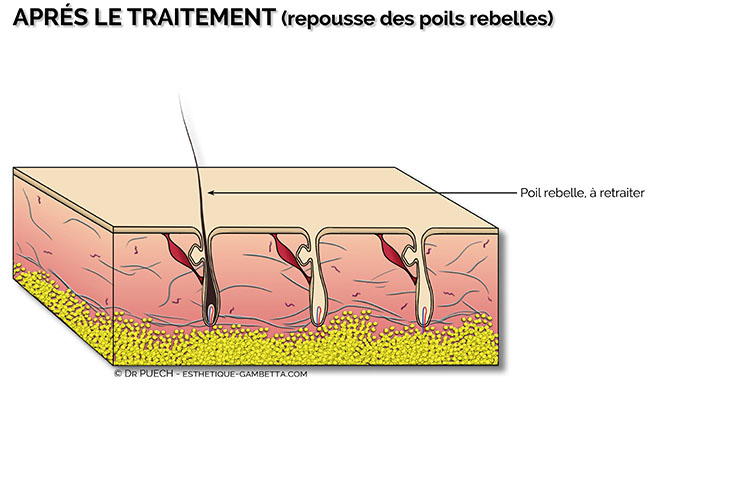 epilation définitive à l'électrolyse