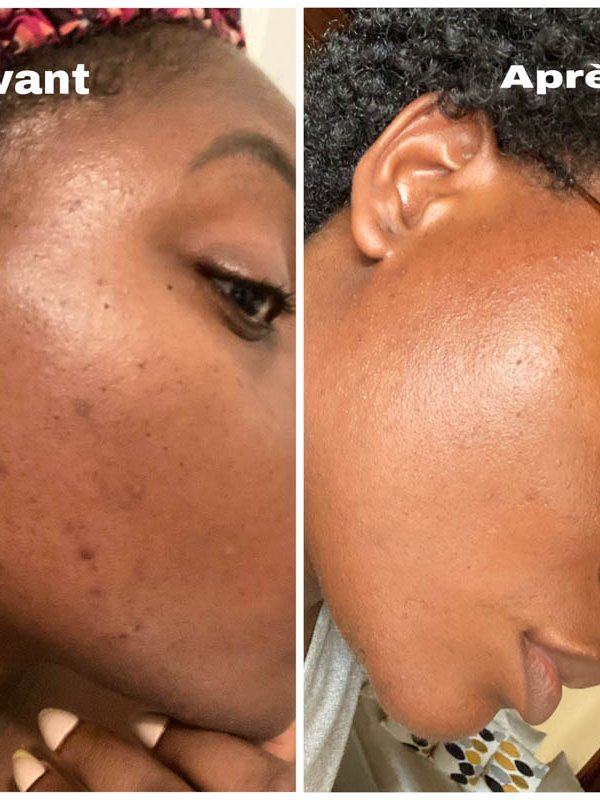 beauté peaux mixtes à imperfections acné nubiance dermocosmetique la revue