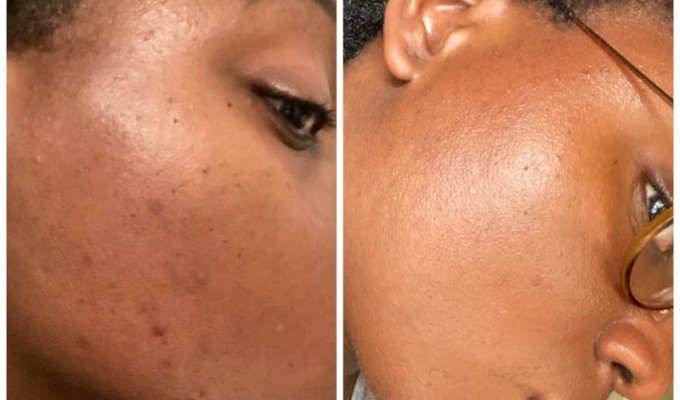 beauté peaux mixtes à imperfections acné nubiance dermocosmetique la revue